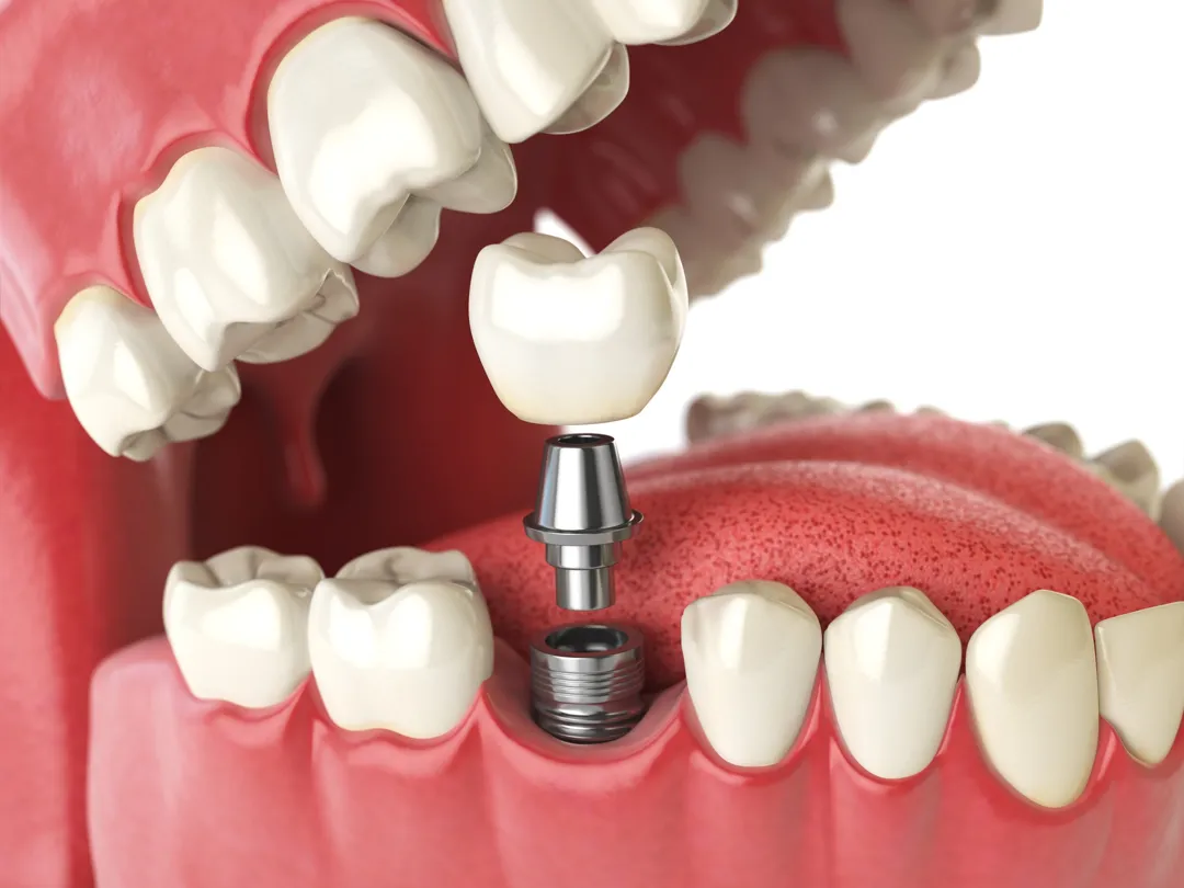 Vue Dental Kyle ad